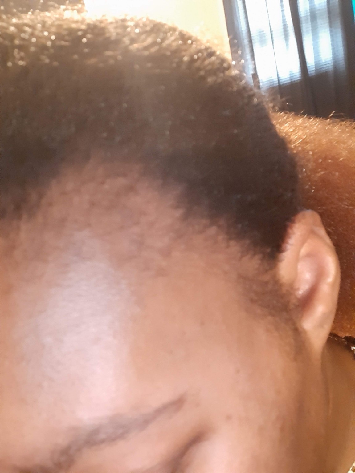 Starting view of the left hairline