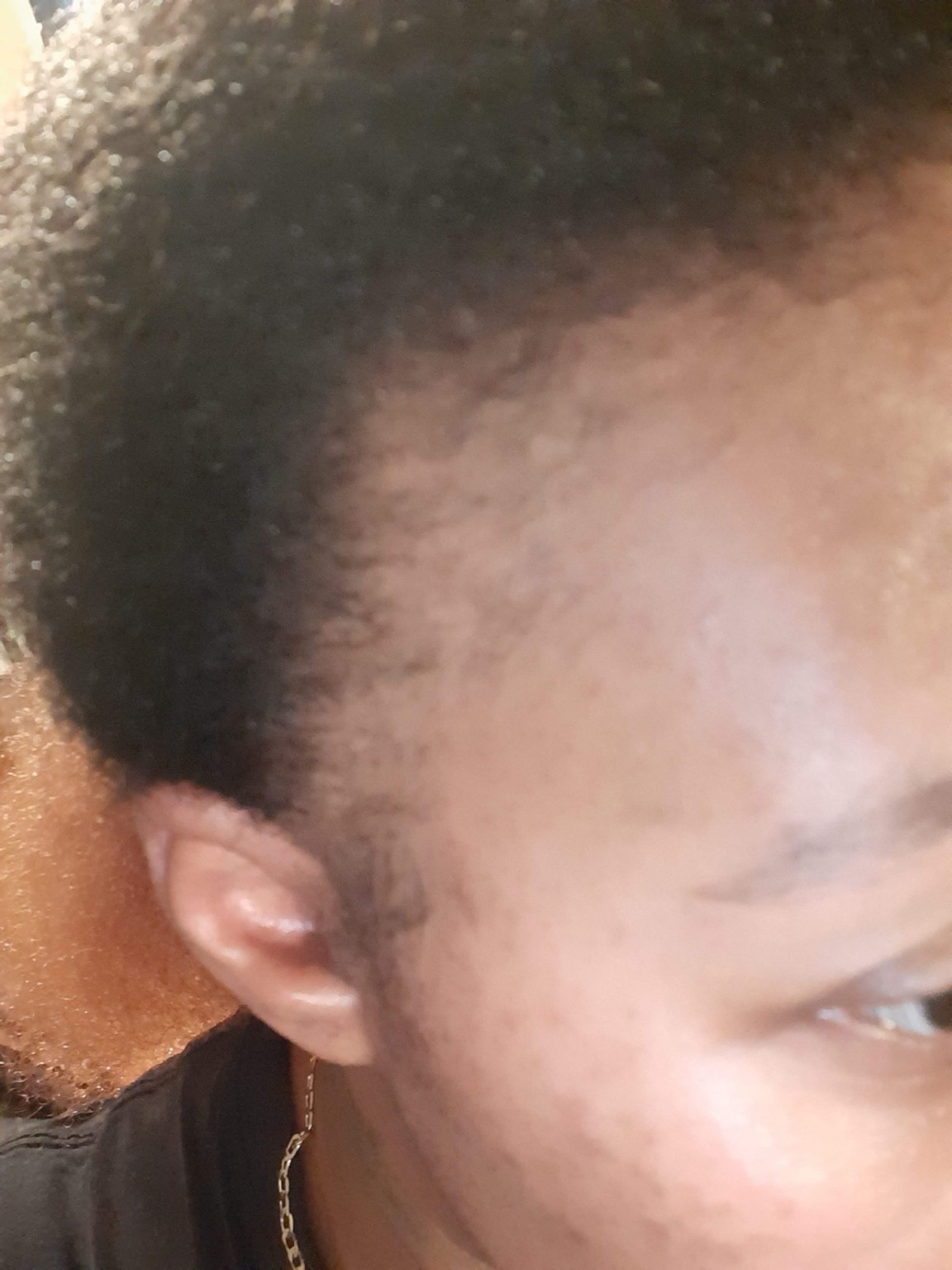 Starting view of the right hairline
